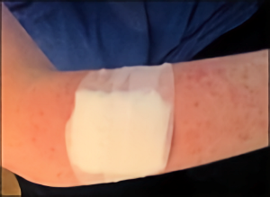 Photo of my bandaged arm post-biopsy