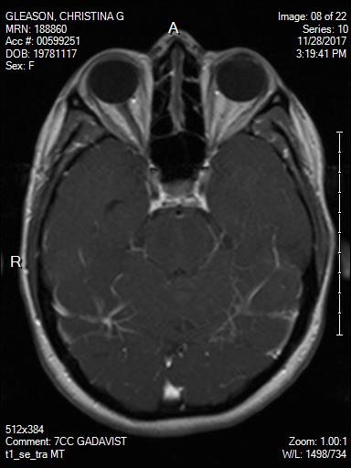 Brain MRI showing optic nerve in black