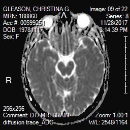 Brain MRI showing optic nerve in white